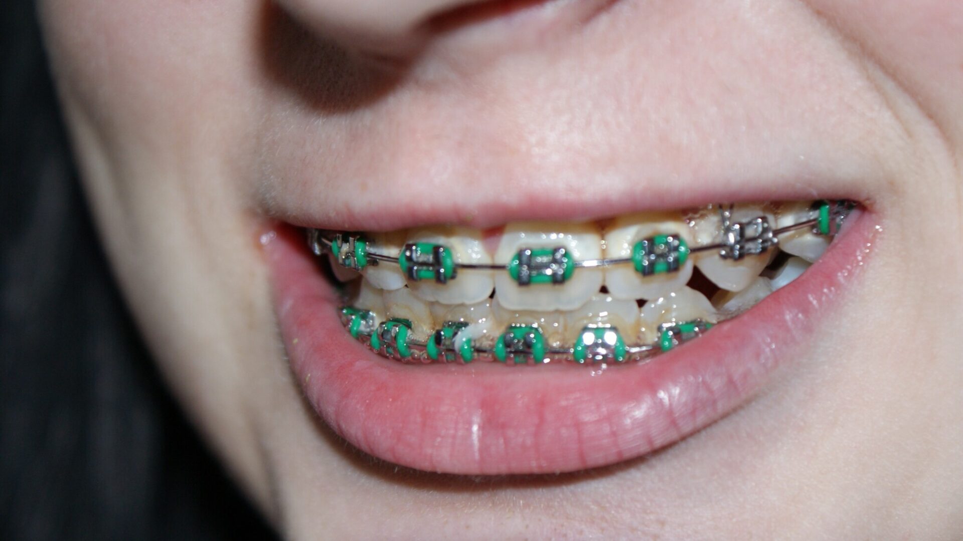 The Benefits of Getting Braces as an Adult - Guymon Orthodontics